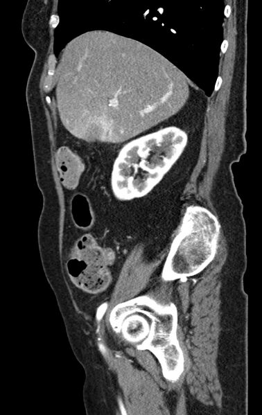 File:Cholecystoduodenal fistula due to calculous cholecystitis with gallstone migration (Radiopaedia 86875-103077 C 45).jpg