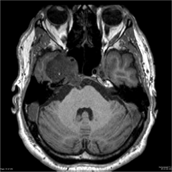 File:Chondrosarcoma of skull base- grade II (Radiopaedia 40948-43654 Axial T1 33).jpg
