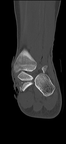 File:Chopart fracture (Radiopaedia 35347-36851 Coronal bone window 24).jpg