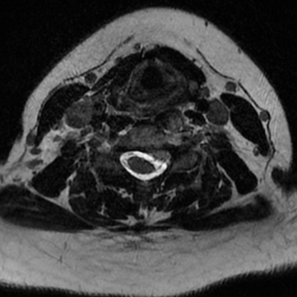 File:Chordoma - cervical spine (Radiopaedia 70084-80111 Axial T2 53).png