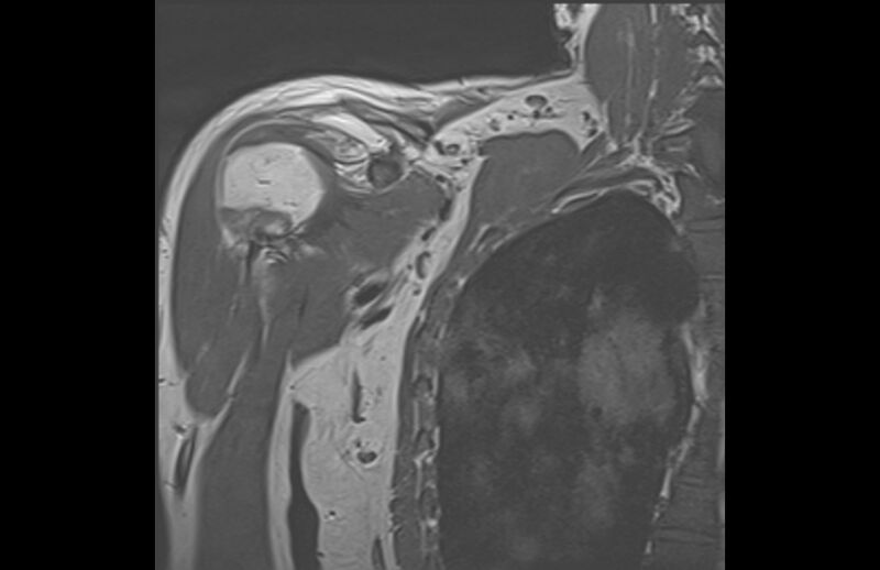 File:Choriocarcinoma in the shoulder (Radiopaedia 28603-28861 Coronal T1 2).jpg
