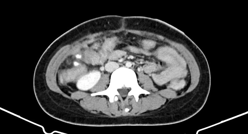 File:Choriocarcinoma liver metastases (Radiopaedia 74768-85766 A 118).jpg