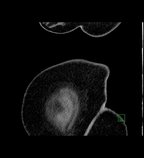 File:Chromophobe renal cell carcinoma (Radiopaedia 84239-99519 D 1).jpg