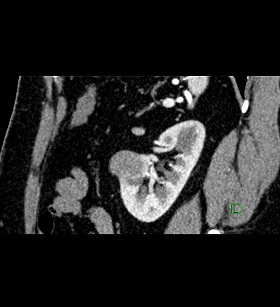 File:Chromophobe renal cell carcinoma (Radiopaedia 84286-99573 F 45).jpg
