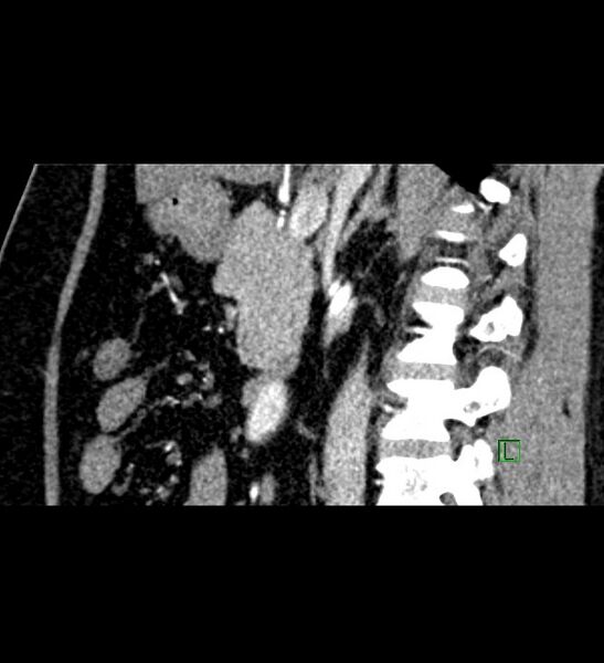 File:Chromophobe renal cell carcinoma (Radiopaedia 84286-99573 F 97).jpg