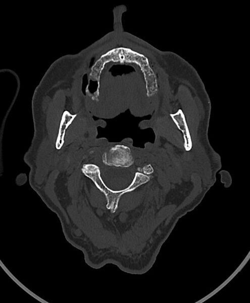 File:Chronic bilateral subdural hygroma (Radiopaedia 85801-101623 Axial bone window 127).jpg