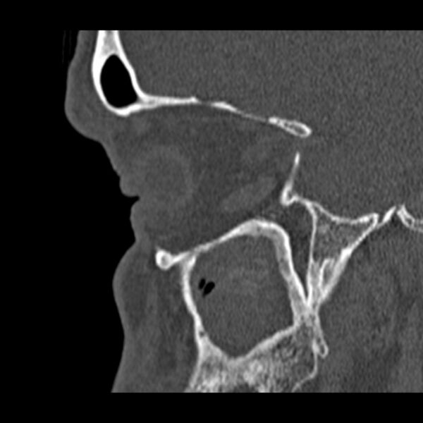 File:Chronic maxillary sinusitis (Radiopaedia 27879-28116 Sagittal bone window 12).jpg