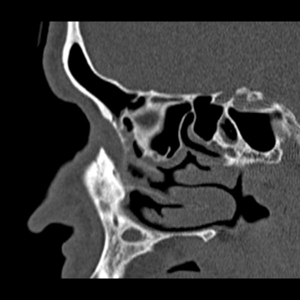 File:Chronic maxillary sinusitis (Radiopaedia 27879-28116 Sagittal bone window 19).jpg