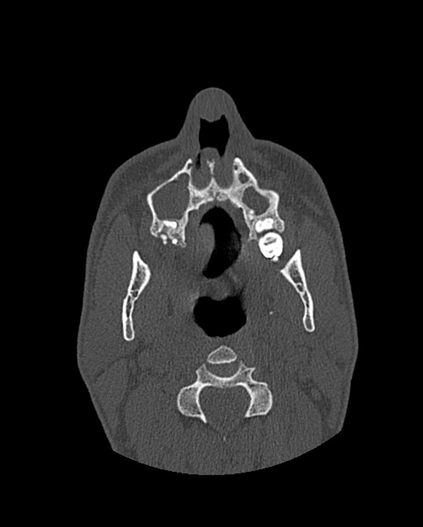 Chronic maxillary sinusitis caused by a foreign body (Radiopaedia 58521-65676 Axial bone window 55).jpg