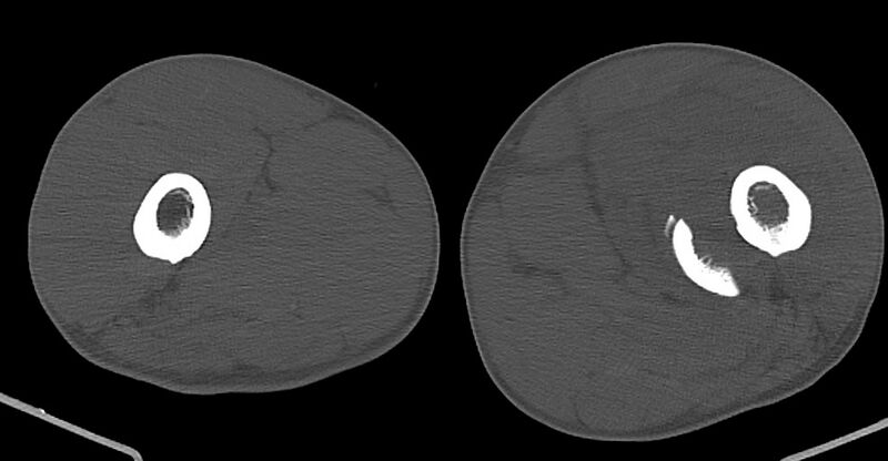 File:Chronic osteomyelitis (with sequestrum) (Radiopaedia 74813-85822 Axial non-contrast 79).jpg
