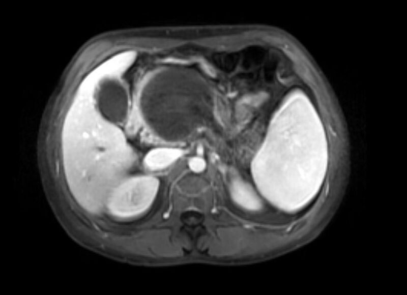 File:Chronic pancreatitis (Radiopaedia 11313-11677 D 1).jpg