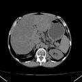 Chronic pancreatitis (Radiopaedia 23132-23172 Axial non-contrast 21).jpg