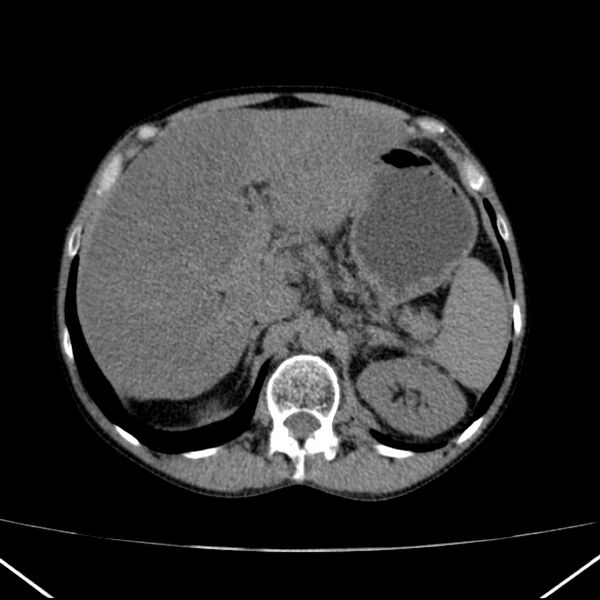File:Chronic pancreatitis (Radiopaedia 23132-23172 Axial non-contrast 21).jpg