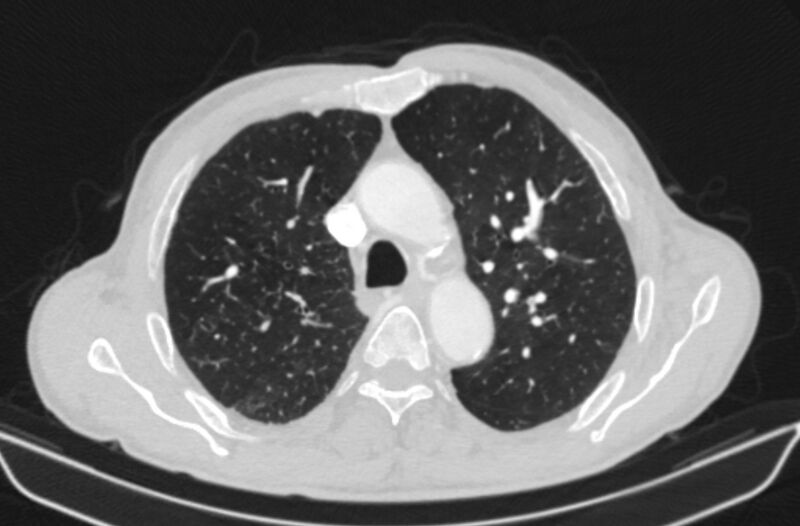 File:Chronic pulmonary embolism (Radiopaedia 91241-108843 Axial lung window 27).jpg