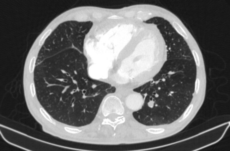 File:Chronic pulmonary embolism (Radiopaedia 91241-108843 Axial lung window 65).jpg