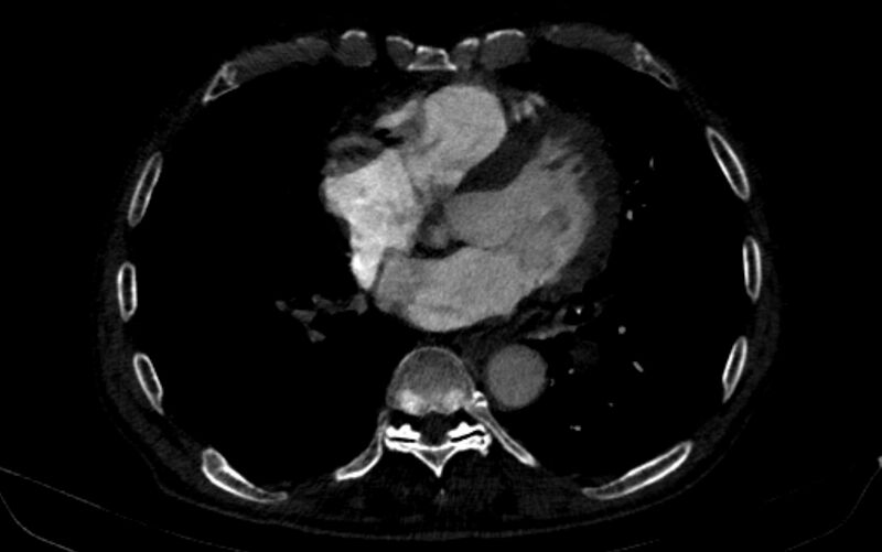 File:Chronic pulmonary embolism (Radiopaedia 91241-108843 B 123).jpg