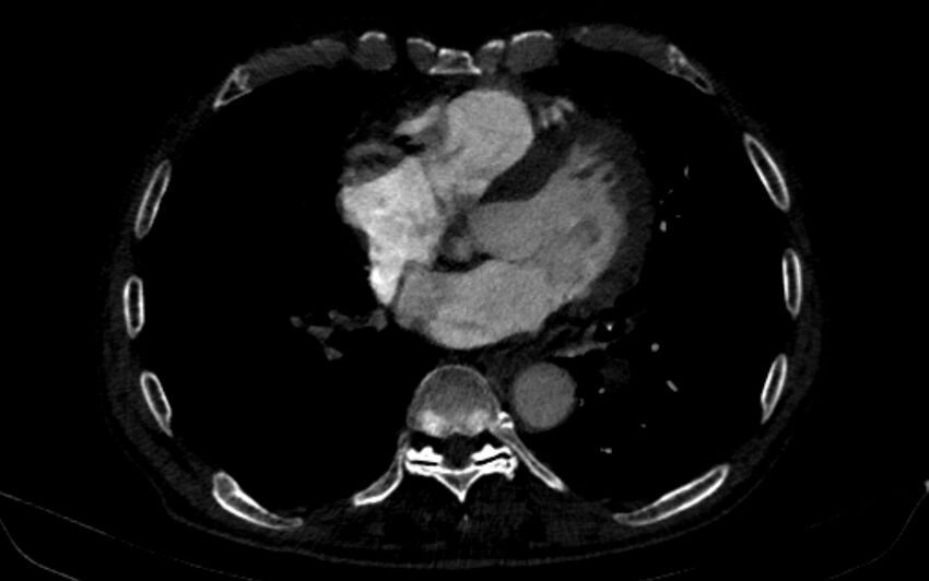 Chronic pulmonary embolism (Radiopaedia 91241-108843 B 123).jpg