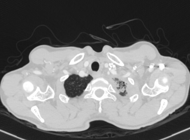 File:Chronic pulmonary embolism with bubbly consolidation (Radiopaedia 91248-108850 Axial lung window 4).jpg