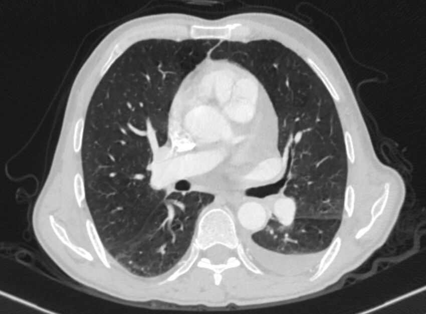 Chronic pulmonary embolism with bubbly consolidation (Radiopaedia 91248-108850 Axial lung window 81).jpg