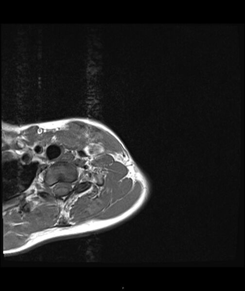 File:Chronic reactive multifocal osteomyelitis (CRMO) - clavicle (Radiopaedia 56406-63071 Axial T1 2).jpg