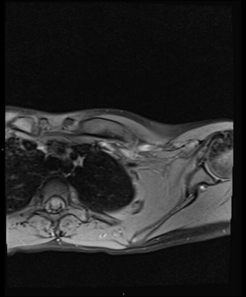 File:Chronic reactive multifocal osteomyelitis (CRMO) - clavicle (Radiopaedia 56406-63114 Axial T1 fat sat 13).jpg