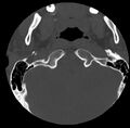 Clay-shoveler fracture (Radiopaedia 22568-22590 Axial bone window 1).jpg