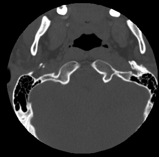 File:Clay-shoveler fracture (Radiopaedia 22568-22590 Axial bone window 1).jpg