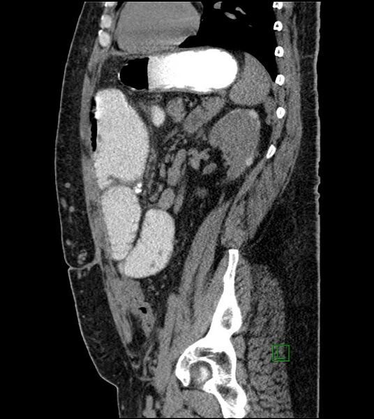 File:Closed-loop small bowel obstruction-internal hernia (Radiopaedia 78439-91096 C 55).jpg