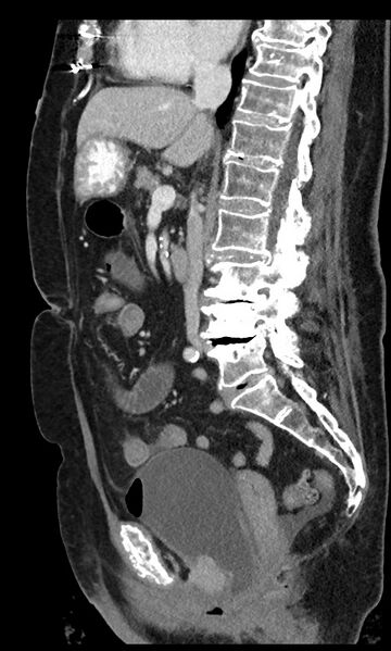 File:Closed loop small bowel obstruction - adhesions (Radiopaedia 59269-66611 C 60).jpg
