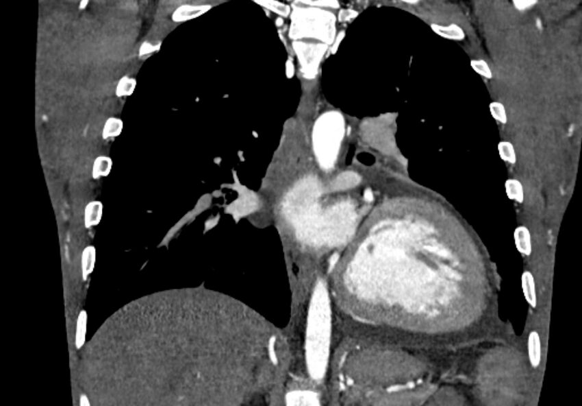 Coarctation of aorta with aortic valve stenosis (Radiopaedia 70463-80574 C 152).jpg