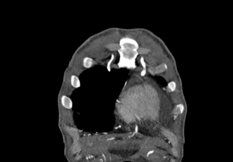 File:Coarctation of aorta with aortic valve stenosis (Radiopaedia 70463-80574 C 4).jpg
