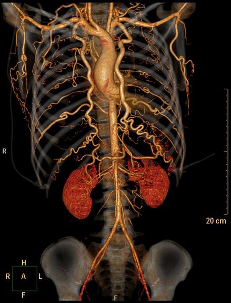 File:Coarctation of the aorta (Radiopaedia 27458-27657 3D 1).jpg