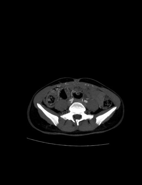 File:Coarctation of the aorta (Radiopaedia 27458-27657 D 39).jpg