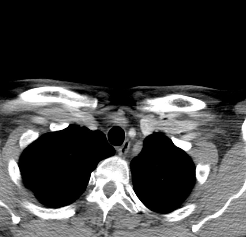 Colloid cyst of thyroid (Radiopaedia 22897-22923 Axial C+ delayed 74).jpg