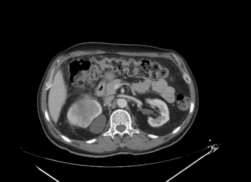 File:Colon cancer mimicking renal cell carcinoma (Radiopaedia 28986-29335 C 27).jpg