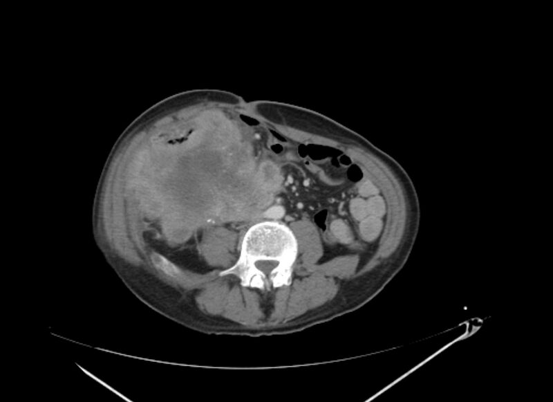 File:Colon cancer mimicking renal cell carcinoma (Radiopaedia 28986-29335 C 45).jpg