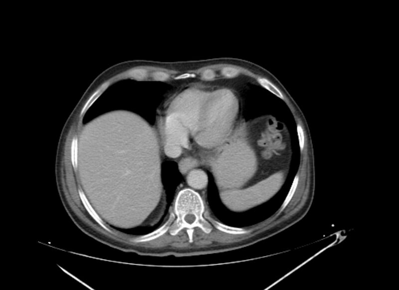 File:Colon cancer mimicking renal cell carcinoma (Radiopaedia 28986-29335 C 6).jpg