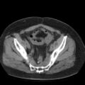 Colonic fistula (Radiopaedia 16047-15707 Axial non-contrast 52).jpg