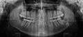 Displaced 3rd molar tooth (Radiopaedia 50383).jpg