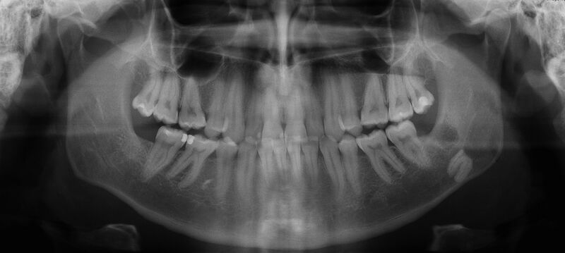 File:Displaced 3rd molar tooth (Radiopaedia 50383).jpg