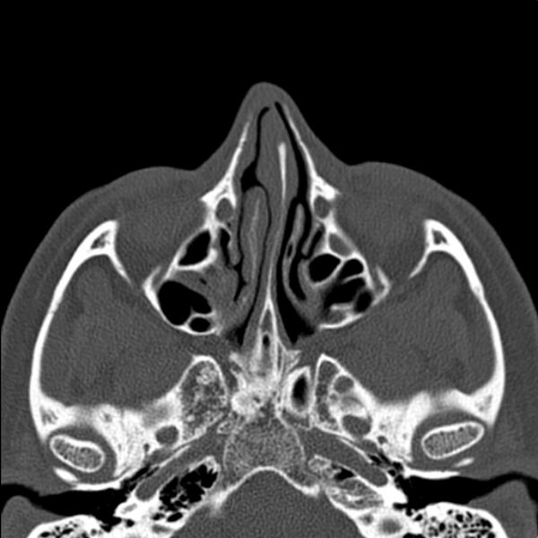 File:Nasal septal perforation (Radiopaedia 25030-25289 Axial bone window 26).jpg