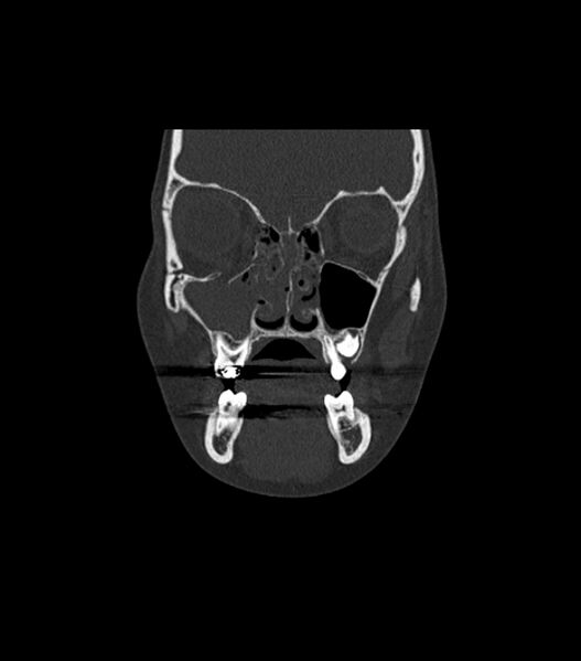 File:Nasoorbitoethmoid fracture (Radiopaedia 90044-107205 Coronal bone window 48).jpg
