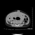 Neonatal neuroblastoma (Radiopaedia 56651-63438 Axial non-contrast 53).jpg