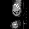 Neonatal neuroblastoma (Radiopaedia 56651-63438 C 15).jpg