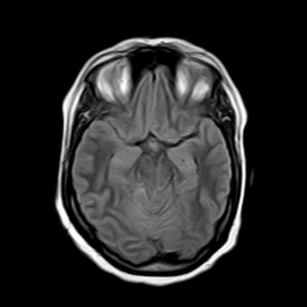 File:Neurofibromatosis type 2 (Radiopaedia 67470-76871 Axial FLAIR 9).jpg
