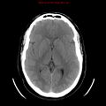 Neuroglial cyst (Radiopaedia 10713-11185 Axial non-contrast 17).jpg