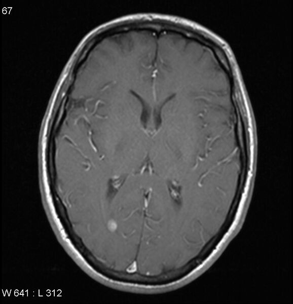 File:Neurosarcoidosis (Radiopaedia 10930-17204 Axial T1 C+ 10).jpg