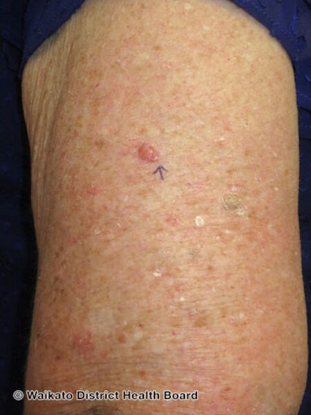 File:Nodular basal cell carcinoma, arm (DermNet NZ nbcc-arm-23-wdhb).jpg