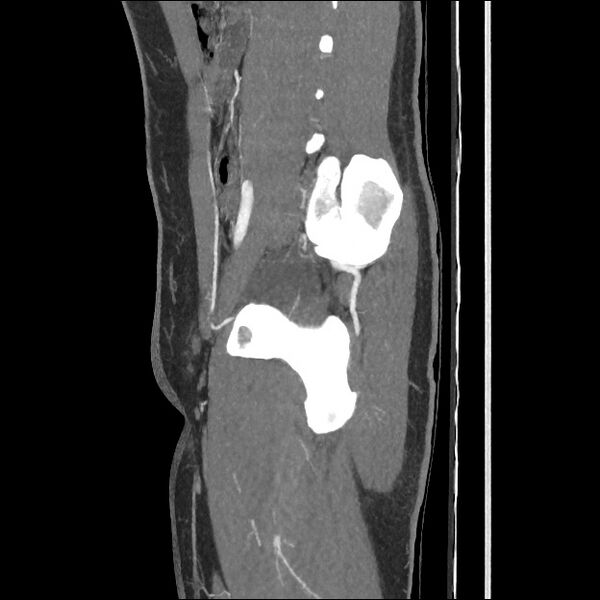 File:Normal CT angiogram of pelvis (Radiopaedia 45390-49430 C 26).jpg