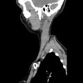 Normal CT of the neck (Radiopaedia 14575-14500 Sagittal C+ 43).jpg